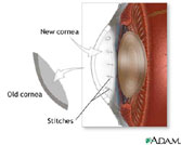 Los Angeles Corneal Transplant Photo