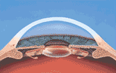 Los Angeles and Beverly Hills Clear Lens Extraction
