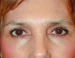 Los Angeles Cosmetic Surgery - Endoscopic Before Photo