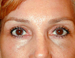 Los Angeles Cosmetic Surgery - Endoscopic After Photo