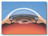 Los Angeles and Beverly Hills Clear Lens Extraction