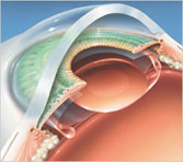 Los Angeles and Beverly Hills Clear Lens Extraction Photo