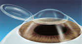 Los Angeles and Santa Monica Laser Vision Correction Photo
