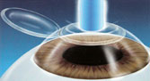 Los Angeles and Santa Monica Custom Ablation Photo