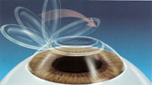 Los Angeles and Santa Monica Laser Vision Correction Picture