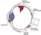Los Angeles Eye Injury