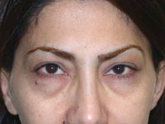 Los Angeles Cosmetic Surgery - Blepharoplasty Before Photo