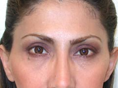 Los Angeles Cosmetic Surgery - Blepharoplasty After Photo