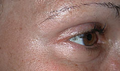 Los Angeles Laser Surgery After Photo