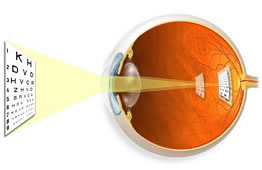 Keratoconus