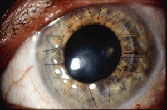 Corneal Transplant Surgery