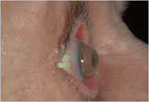 Los Angeles and Santa Monica Keratoconus Photo