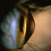 Los Angeles and Santa Monica Keratoconus Patient Photo