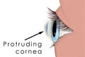 Los Angeles and Santa Monica Keratoconus Photo
