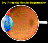 Los Angeles Macular Degeneration