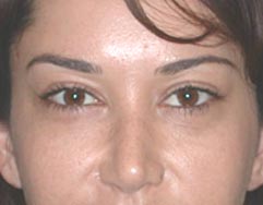 Los Angeles Cosmetic Surgery - Midface Lift After Photo