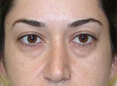 Los Angeles Cosmetic Surgery - Midface Lift Before Photo