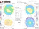 Los Angeles and Santa Monica Custom Lasik