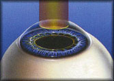 Los Angeles and Santa Monica Laser Vision Correction Picture