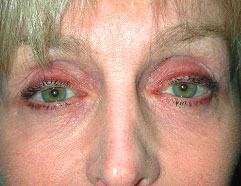 Los Angeles Reconstructive Surgery Before Photo