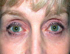 Los Angeles Reconstructive Surgery After Photo