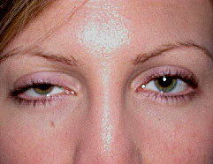 Los Angeles Cosmetic Surgery - Ptosis Before Photo