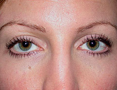 Los Angeles Cosmetic Surgery - Ptosis After Photo