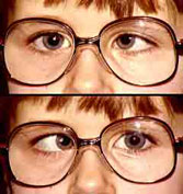 Santa Monica and Los Angeles Strabismus Patient