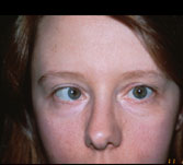 Santa Monica and Los Angeles Vision Correction Patient