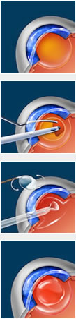 Cataract Surgery