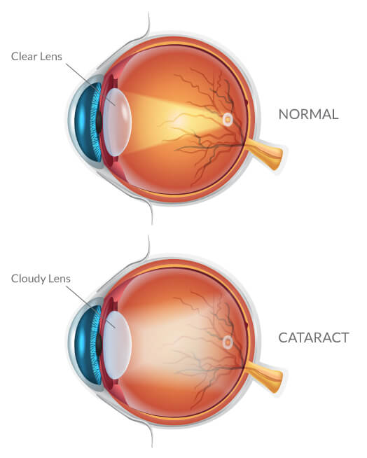 Cataract Diagram