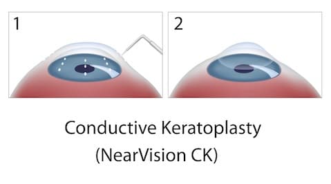 Conductive Keratoplasty Diagram