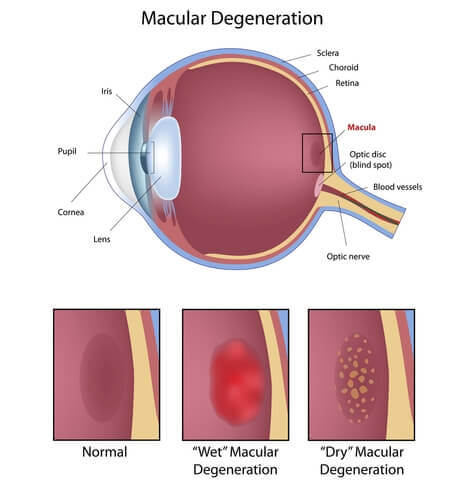 Macular Degeneration Diagram