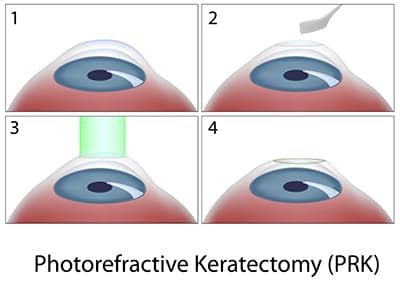 PRK Diagram