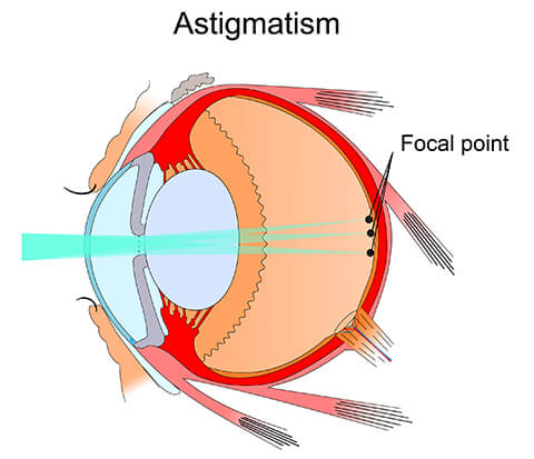 Astigmatism Diagram