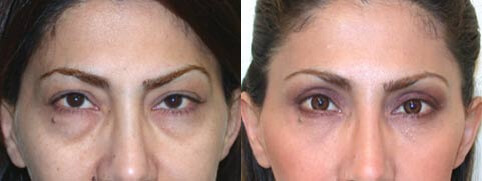 Eyelid Lift (Blepharoplasty) Before and After