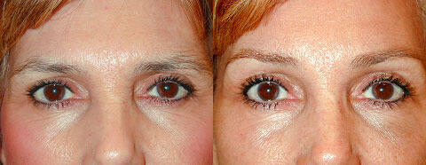 Endoscopic Brow Lifts Before and After