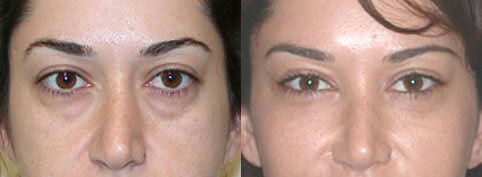 Cheek Lift Before and After