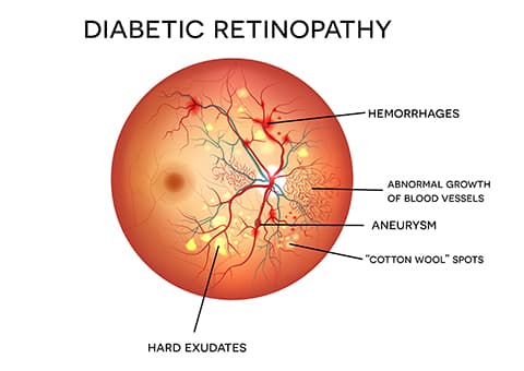 Diabetic Retinopathy Diagram