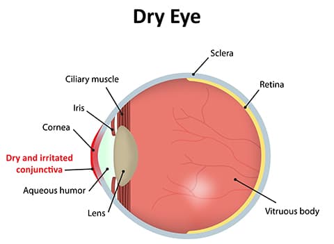 Dry Eyes Diagram