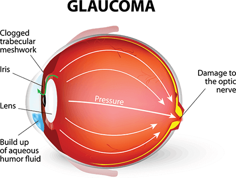 Glaucoma diagram