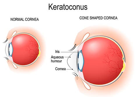 Keratoconus Diagram