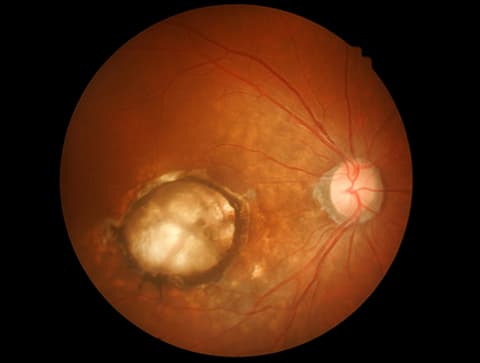 Macular Degeneration Retina Photograph