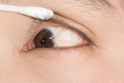 Close up of pterygium duing eye examination
