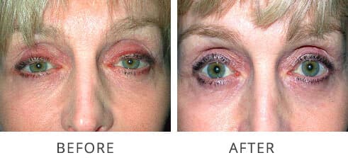 Ptosis Reconstructive Before and After