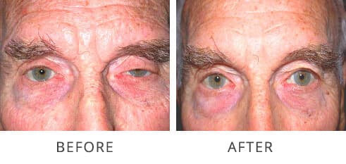 Ptosis Reconstructive Before & After