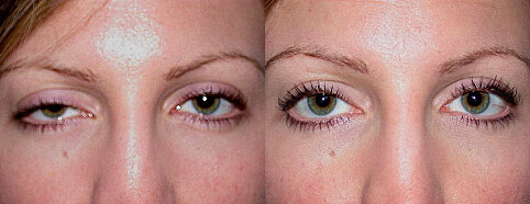 Ptosis Before and After